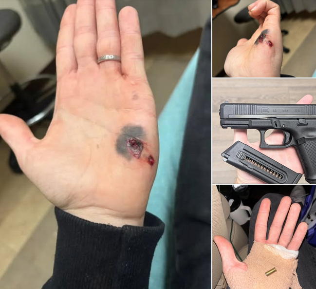 hand ND negligent discharge wound