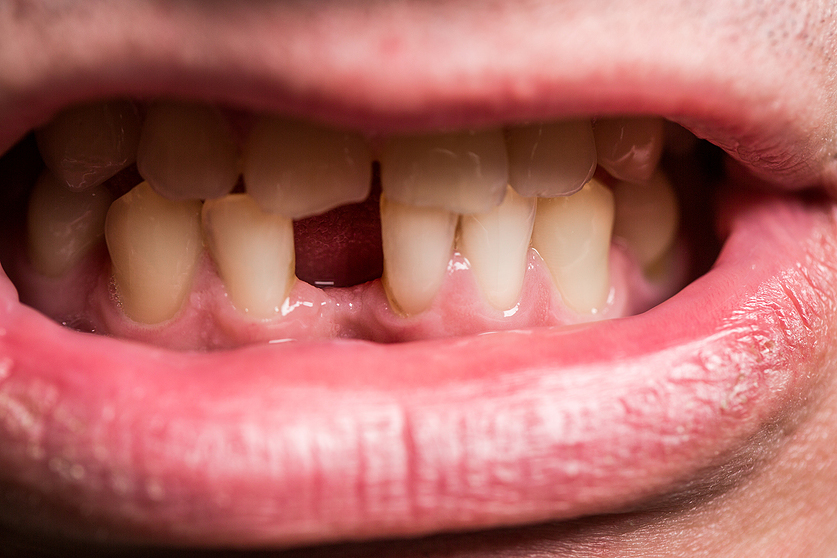 Man Without One Front Tooth. Bad Dental Health, No Teeth, Bad Teeth